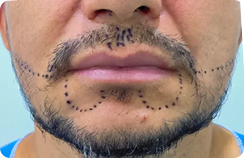 antes