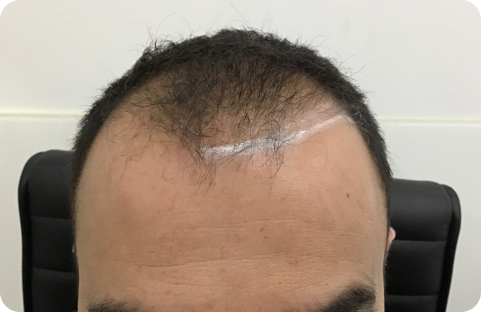 antes