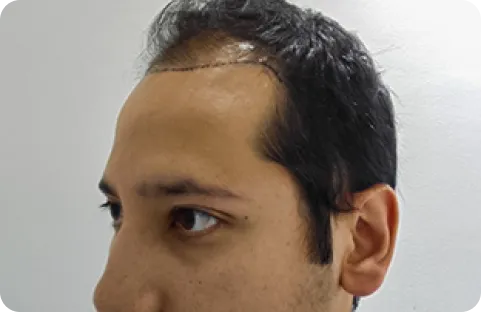 antes